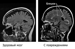 Сравнение здорового мозга и пораженного рассеянным склерозом