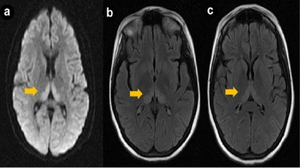 МРТ энцефалопатии - поражение головного мозга